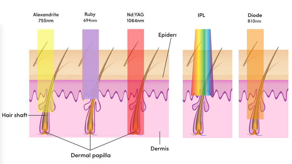 different laser hair removal