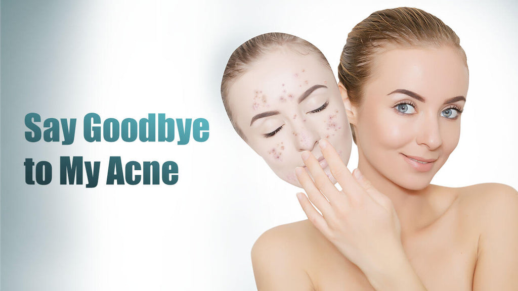 acne removal treatments