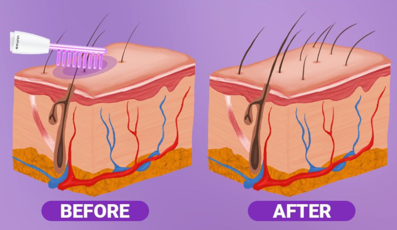 high frequency for hair growth